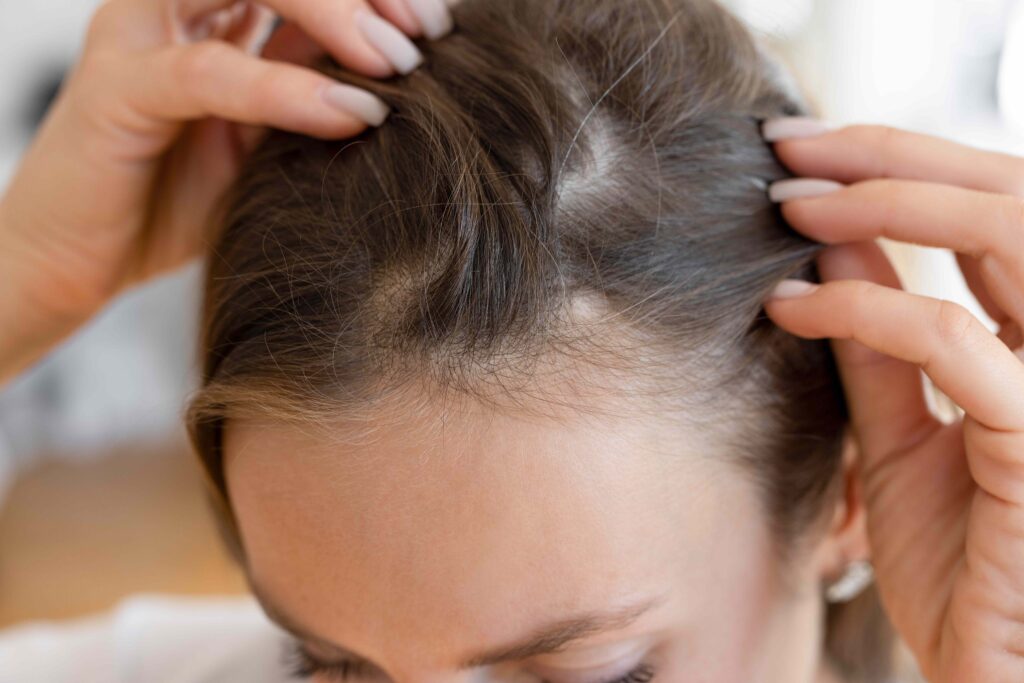 How Dandruff Could Be Affecting Your Hair Health