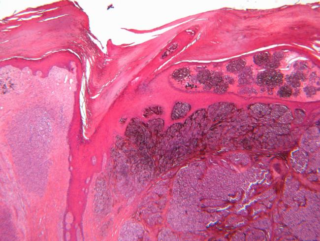 NIH-funded AI model predicts cancer survival from single-cell tumor data