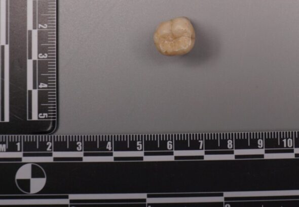 Protein in Homo erectus teeth suggests Denisovans gave us some of their DNA