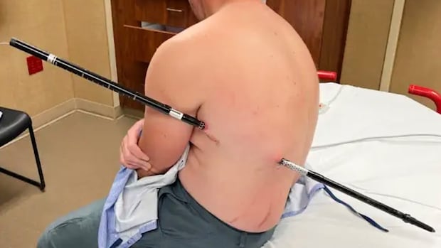 Montana man hikes out of mountains after getting impaled by trekking pole
