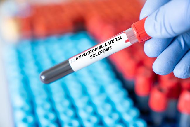 New blood-based biomarkers predict when ALS symptoms will emerge   | National Institutes of Health (NIH)
